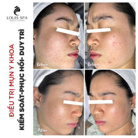 Điều trị mụn phan thiết