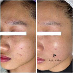 Peel da và những điều cần biết