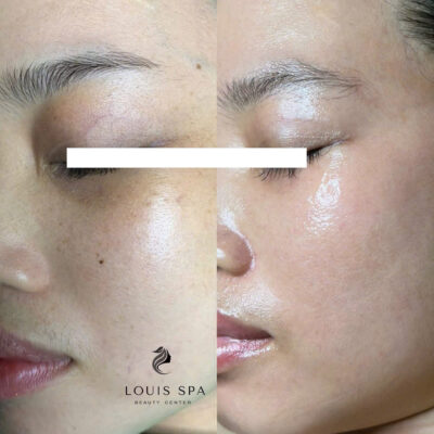 Trước và sau khi trị nám và tàn nhang tại Luis Spa