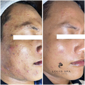 trị mụn tại phan thiết